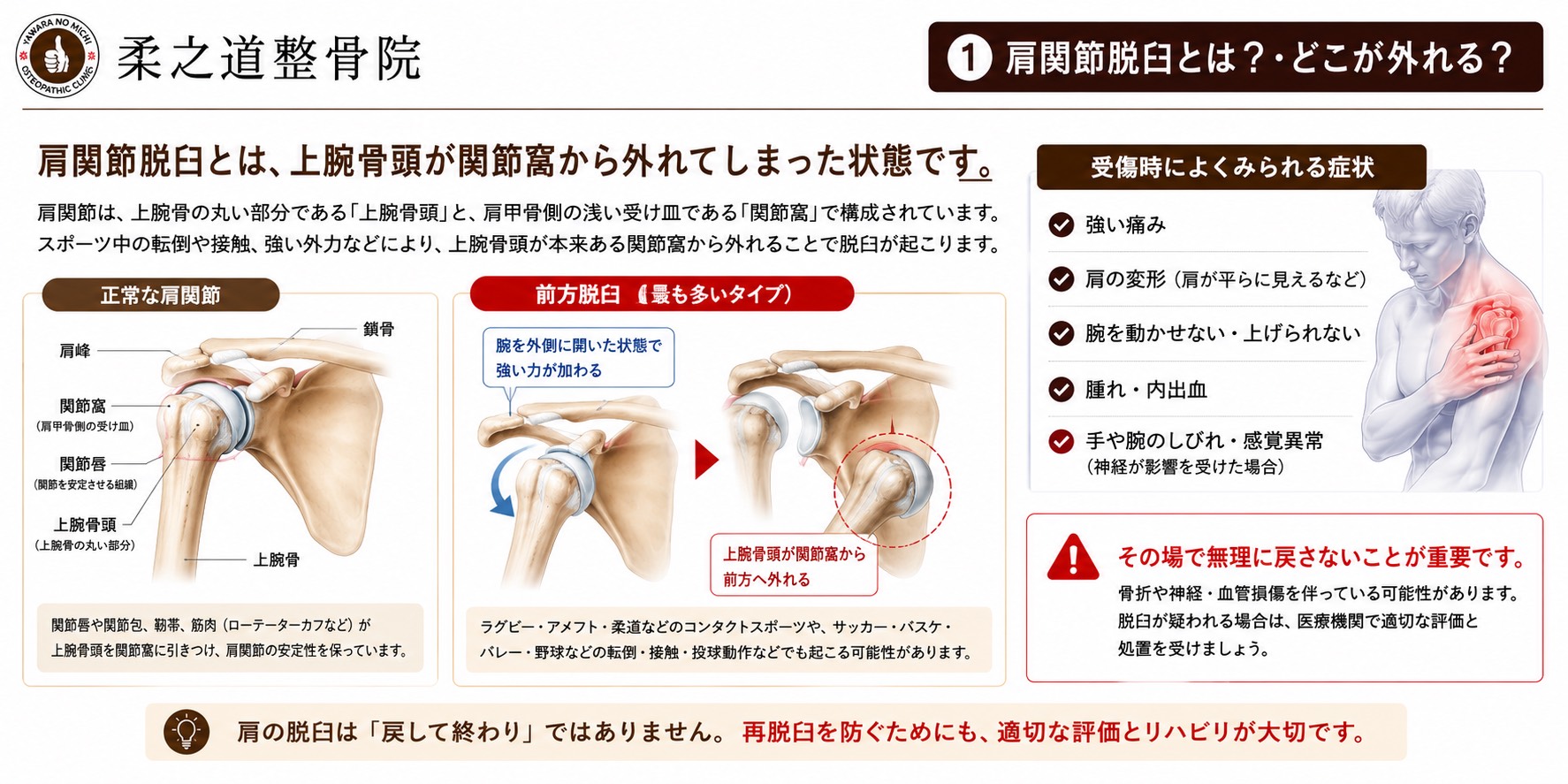 肩関節脱臼とは？