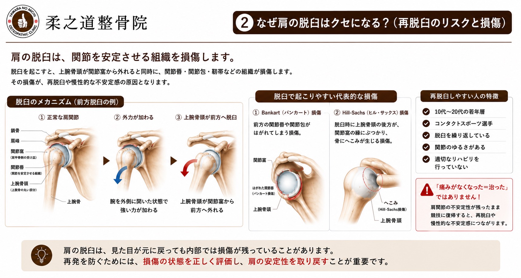 なぜ肩の脱臼はクセになる？