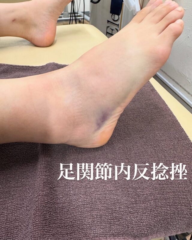 ⚽️今週の外傷シリーズ⚽️
サッカーの方が多く来院されてますので、大会やリーグ戦が始まり怪我も増えてきてますね😭
中には、プロレスごっこしてて足首を捻った方も、、、
写真撮れてませんが、他にも肋骨骨折や足の指の脱臼などたくさんの症例があります🫡
最後の吸玉は全身の流れを良くしてあげることにより、身体の疲労も抜いてあげることができますよ☀️
.
早期復帰には早期ケアです🙋‍♂️
早めの対処がその後の復帰の時間が決まります！！
多分、大丈夫ではなく怪我したらすぐにご連絡を🙏

怪我は是非、当院に🙏
#柔之道整骨院
#ミキハウスフットサルクラブ
#テクノネット大阪 
#エレサス
#アキュスコープ
#メディセル
#ヘリオジャパン
#クロスコレクト 
#リミーエコツーペースト 
#スポコラ 
#スポーツ#疲労回復
#美容鍼#美容
#肉離れ#捻挫
#大阪#堀江#難波#心斎橋
#整骨院#整骨院大阪
#怪我#サッカー
#フットサル
#football#soccer#futsal